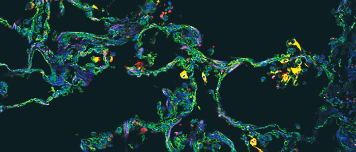An image from the front cover of the journal JCI Insight from July 2021. The cover image shows SPP1+ macrophages in alveoli in a COVID-19 postmortem lung, with immunostaining for SPP1 (green) and the macrophage marker CD68 (red). Nuclei were stained with DAPI (blue).